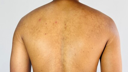 Skin Hyperpigmentation on Back and Shoulder