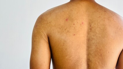 scars on human back acne. used for health