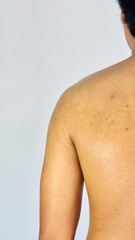 Naklejka premium Human Back with Acne and Skin Blemishes