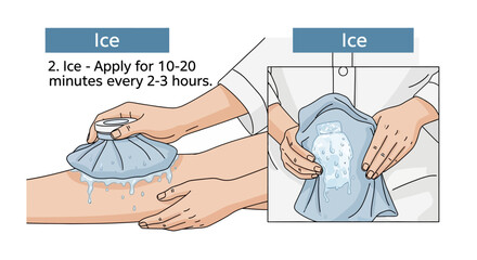 Applying an ice pack to leg for pain relief and swelling reduction, with instructions for duration and frequency