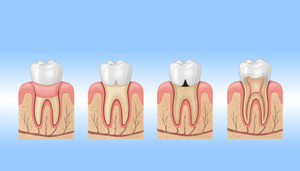 Dental decay progression visualization dental office educational illustration clinical environment close-up view oral health awareness