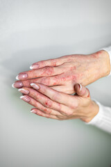 Fototapeta premium Hands showing signs of eczema, contact dermatitis, and other skin conditions in a close-up view