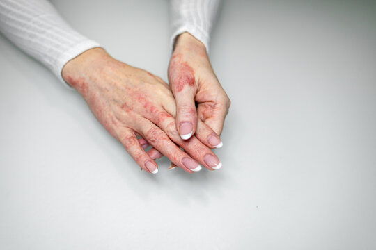 Hands affected by eczema showcasing redness and irritation after contact dermatitis in a neutral setting - Powered by Adobe