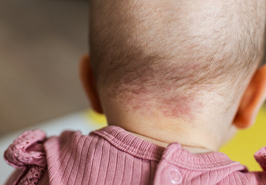 Close-Up of a Baby's Nape Showing a Port Wine Stain Birthmark