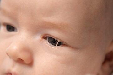 Baby eyes with eye mucus in selective focus. Disease tear ducts tons of newborns close up. Nasolacrimal duct obstruction in baby it is a blockage of the lacrimal drainage system. 