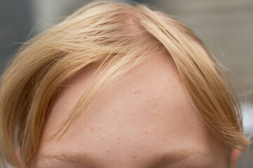 Close-up of a young person&rsquo;s forehead with mild acne and natural blonde hair, illustrating real skin texture and imperfections.