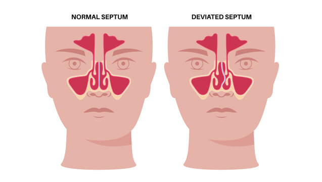 Deviated septum poster