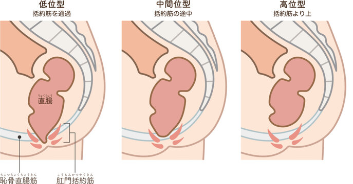 鎖肛のイラスト、imperforate anus(ARM) illustration