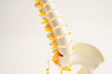 Naklejka premium Spinal nerve and bone, Lumbar spine displaced herniated disc fragment, Model for treatment medical in the orthopedic department.