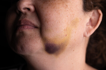 Obraz premium Close-up of a woman’s face with a bruise on the cheek – injury, healing process, and skin discoloration.