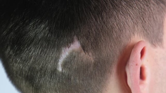 A dog bite scar on a man's head