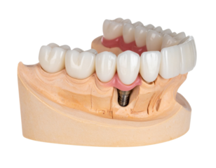 Dental Veneers Close-Up on Lower Jaw Model – Precision Cosmetic Restoration