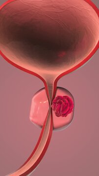 Prostate Gland Cancer Development Shown in Medical Animation