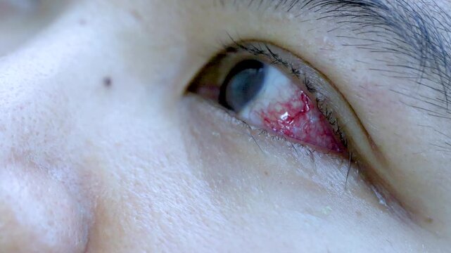 Close-Up of Bloodshot, Irritated Human Eye With Redness