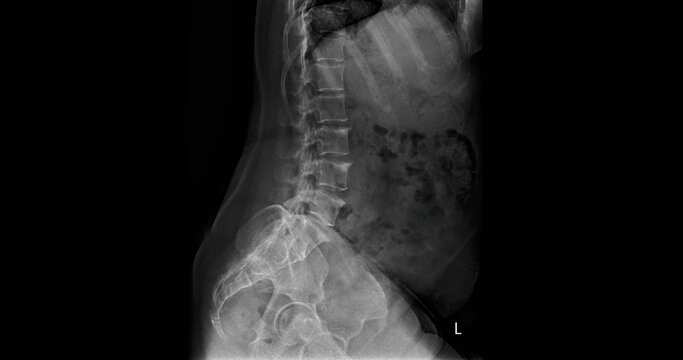 
Lumbar spine x-ray showing vertebrae, intervertebral discs and pelvic bones. AP and lateral view radiographs for diagnostic examination of lower back anatomy
