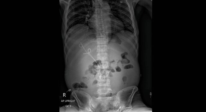 Abdominal x-ray showing bowel gas pattern, lumbar spine and pelvic bones. AP upright and lateral view radiographs for diagnostic examination of abdomen anatomy