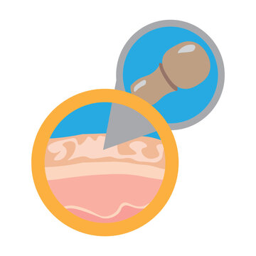 Tinea Versicolor Skin Disease