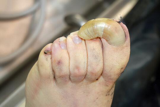 Severe Onychogryphosis Claw Toe Nail Foot Forensic Medical Pathology