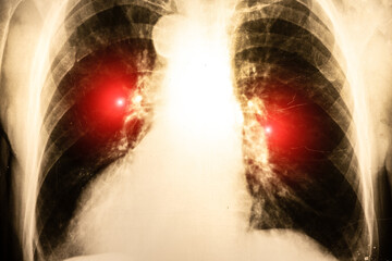 X-ray picture with pneumonia, fluorography. Diagnostics of human lung and respiratory tract diseases.