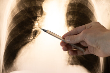 Doctor learn X-ray picture with pneumonia, fluorography. Diagnostics of human lung and respiratory tract diseases.