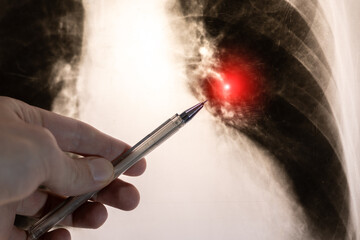 Doctor learn X-ray picture with pneumonia, fluorography. Diagnostics of human lung and respiratory tract diseases.