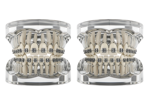 Orthodontic dental models with metal braces for teeth alignment. isolated on transparent background - Powered by Adobe