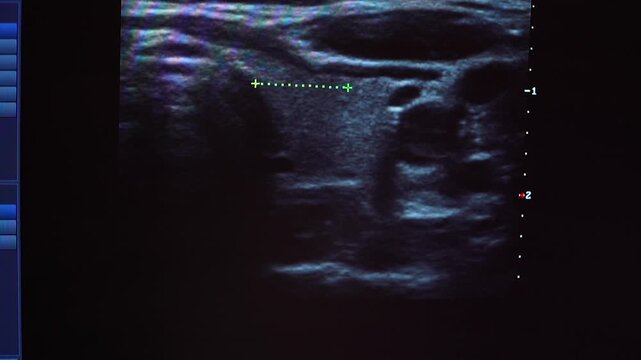 ultrasound scanning of the thyroid gland. Ultrasound image of thyroid gland. Ultrasound scan imaging of thyroid gland
