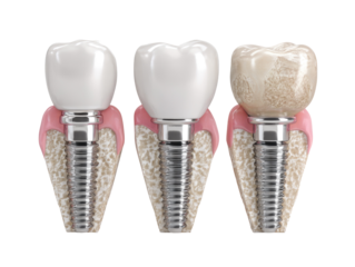 A dental illustration displaying three teeth with implants. The left and center are white, and the right tooth appears stained