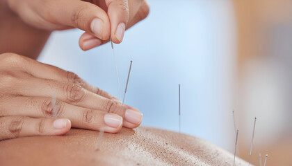 Acupuncturist's hand carefully inserts needle into patient's skin for traditional Chinese medicine treatment