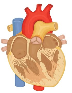 Detailed anatomical illustration of ventricular septal defect (VSD) showing internal heart chambers on white background