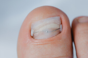 After ingrown toenail recovery with brace titanium thread, medical podiatrist treatment