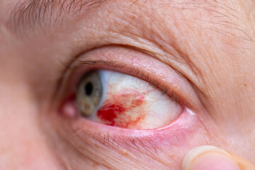 Fototapeta premium Close-up human eye with severe redness and broken blood vessels, showing subconjunctival hemorrhage, clinical detail for medical, health, and ophthalmology concepts, patient healing, blood vessel