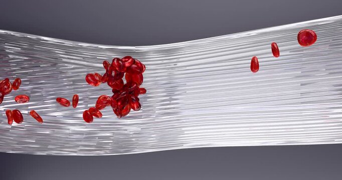 3D abstract animation of a blood clot forming within a cross-section of a blood vessel (artery, vein). Embolus within the bloodstream, vessel narrowing.