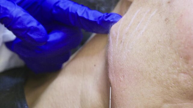 Aesthetic medicine doctor performing pdo thread lifting procedure