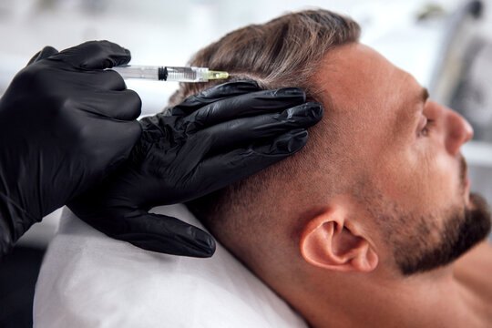Male undergoing hair restoration treatment with a syringe, showcasing the procedure in a modern clinic environment, emphasizing self-care and confidence enhancement