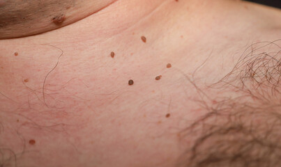 Fototapeta premium ​A macro shot of light human skin, showing numerous brown moles of varying sizes and individual hairs. The detailed focus on the skin surface allows for discernment of texture and the clustering of so