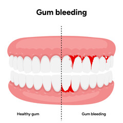 Hand-drawn illustration of healthy teeth and gums alongside bleeding gums, dental and oral anatomy. Dental education, oral health guides, and professional dentistry content