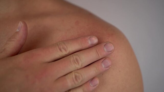 Bee sting on male shoulder in close up, 4K