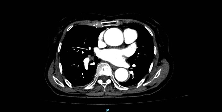 Chest CT scan showing heart, great vessels and mediastinal structures. Axial view with contrast enhancement for diagnostic examination of thoracic anatomy