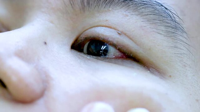 Close-Up of Bloodshot Eye With Conjunctival Irritation and Tears