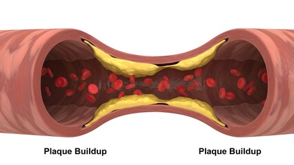 Cholesterol plaque in artery (atherosclerosis) illustration 