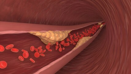 Cholesterol plaque in artery (atherosclerosis) illustration 