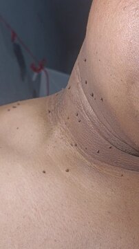 Men with Warts, Skin Tags, or Moles on Dark Skin: Common Skin Lesions and Cosmetic Treatments