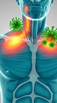 Medical illustration of a human torso showing viral infection with pain and inflammation in the neck and shoulder regions.