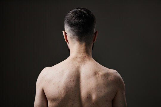 Unrecognizable young man showing bare back with visible acne and skin blemishes, skincare concept