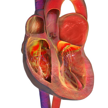Left atrial enlargement, 3D illustration
