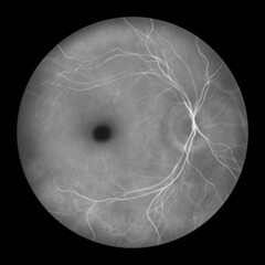 Best disease stage 2, illustration