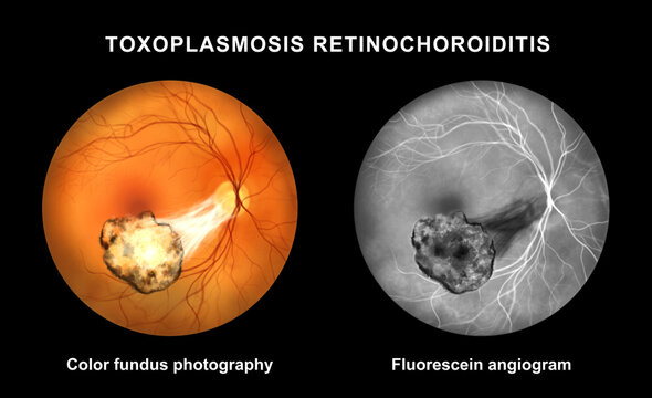 Toxoplasmosis retinochoroiditis, illustration