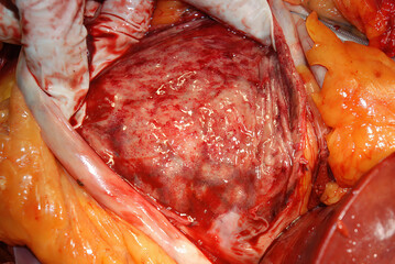 Acute Hemorrhagic Gastritis Stomach Serosa Surface Necropsy Finding