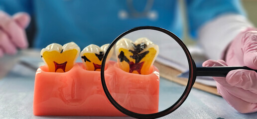 Dentist examines model teeth with decay under a magnifying glass